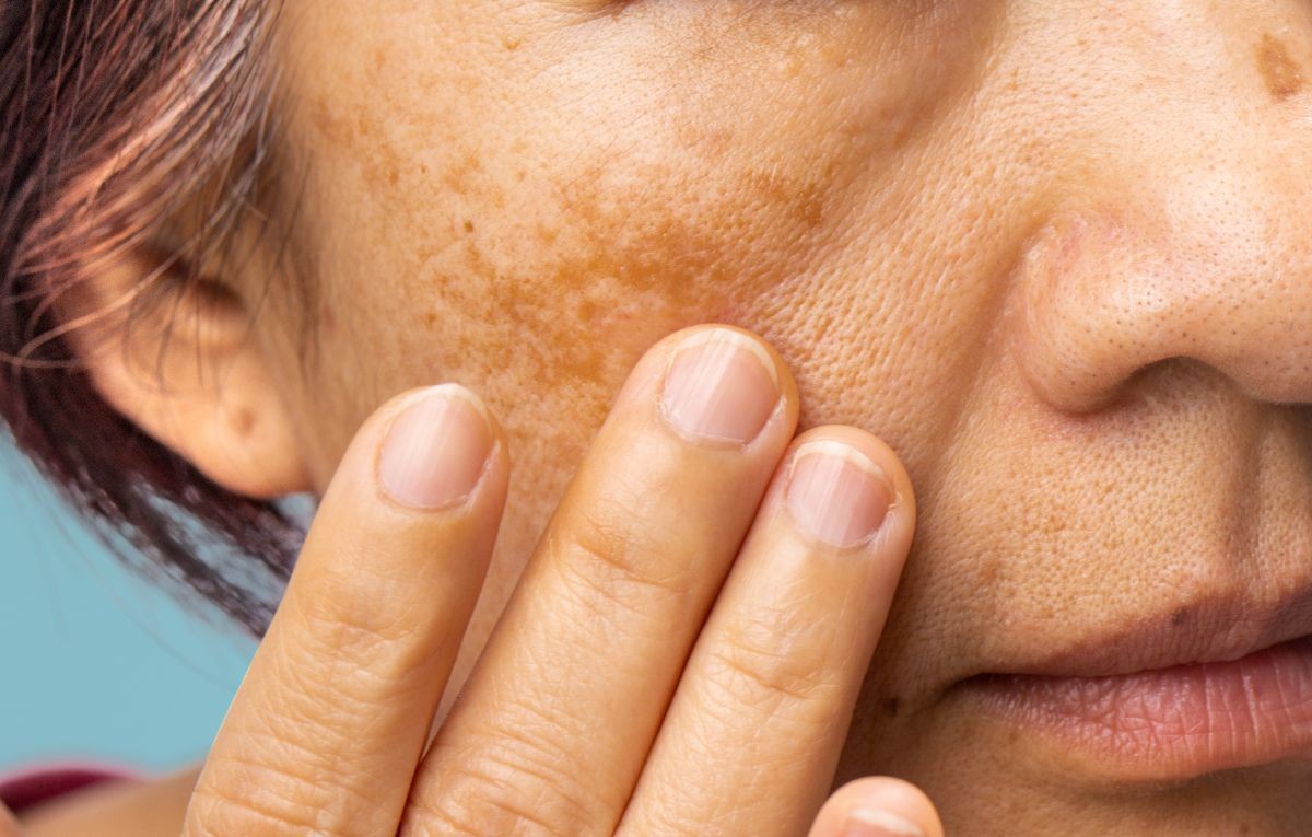 Por que surge o melasma? Descubra como melhorar e tratar essas manchas de forma eficaz